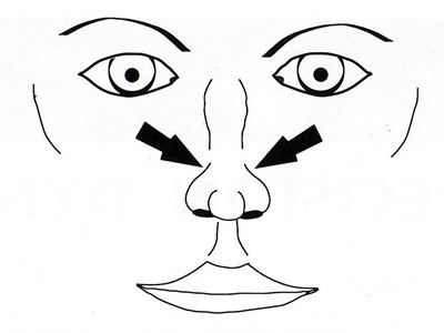 El colapso de los tejidos blandos es visible principalmente por encima de las fosas nasales, en la zona de la hendidura.