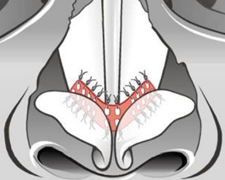 Posición del implante Breathe en el cartílago triangular (esquema)